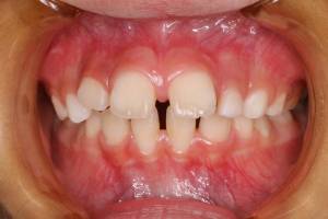 舌の癖と歯並び