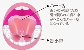 舌小帯が短い 舌小帯が短い