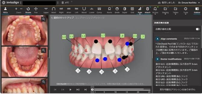 歯の動きのシミュレーション 歯の動きのシミュレーション